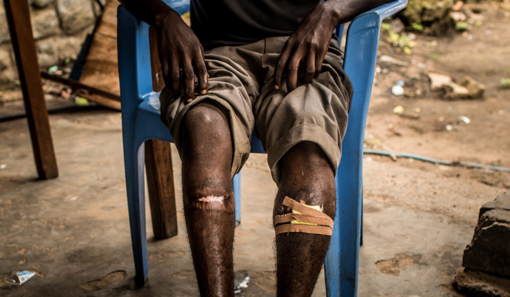 This teenage child soldier endured painful gunshot wounds in battle, after he was pressured to join the militia movement to avoid further torture or arrest. A surge in violent conflict in the Democratic Republic of Congo has forced many people (much like the teenager pictured) from their homes. © UNICEF / Vincent Tremeau