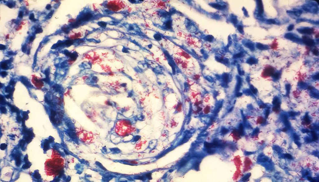 Photomicrograph of a skin tissue sample from a patient with leprosy reveals a cutaneous nerve invaded by numerous Mycobacterium leprae bacteria. Photo by Arthur E. Kaye, CDC